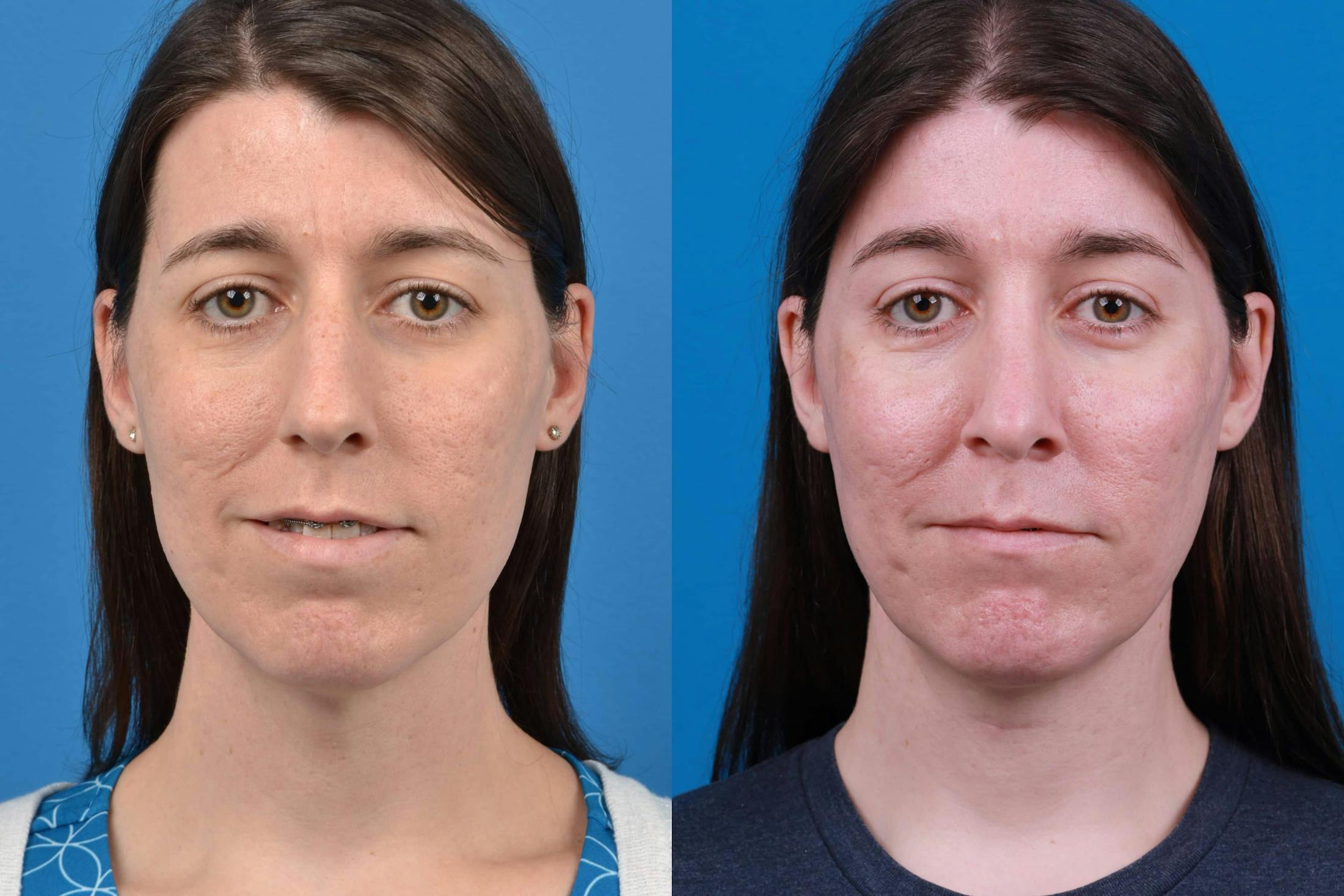 Facial Feminization Before & After Gallery - Patient 122595434 - Image 3