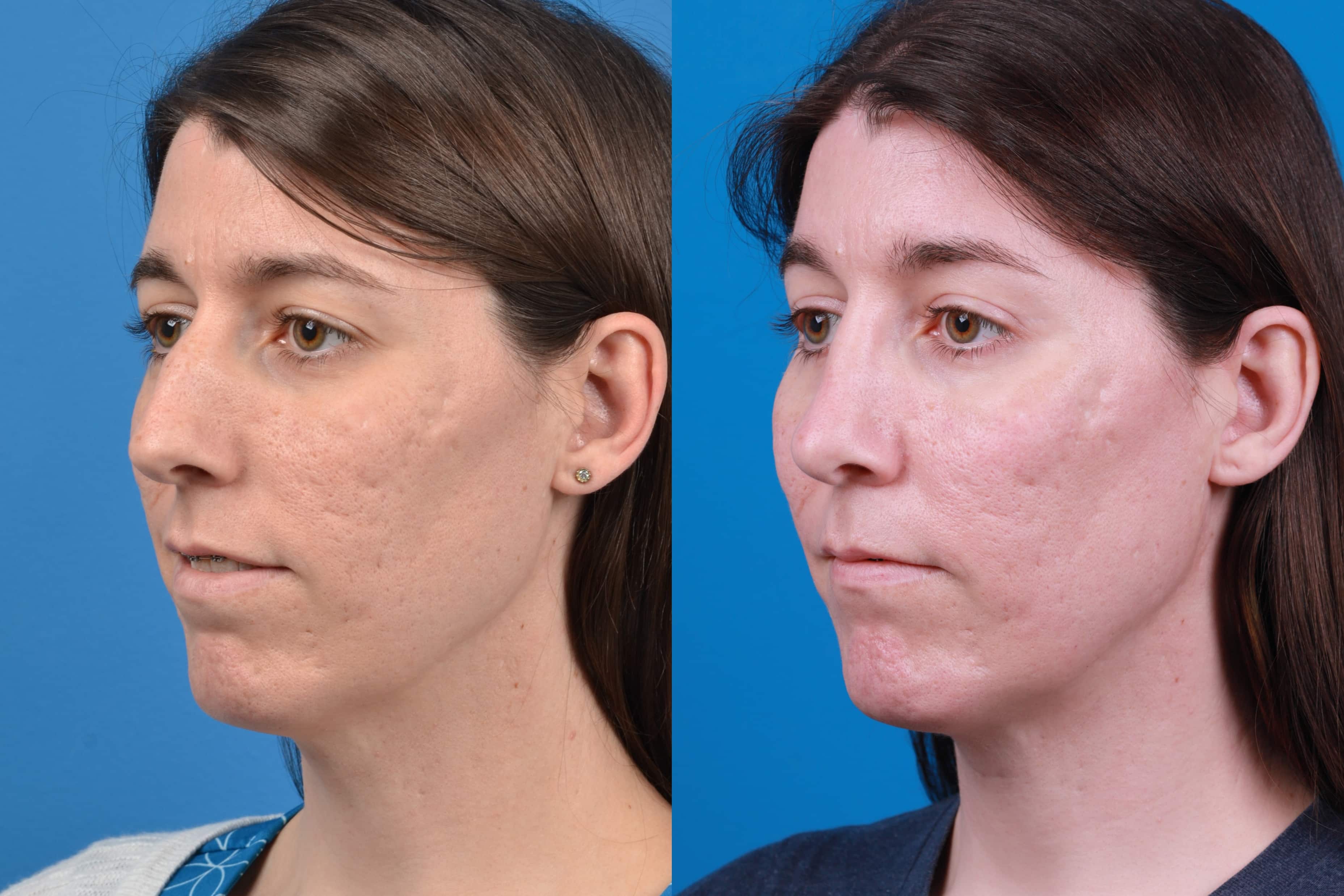 Facial Feminization Before & After Gallery - Patient 122595434 - Image 2