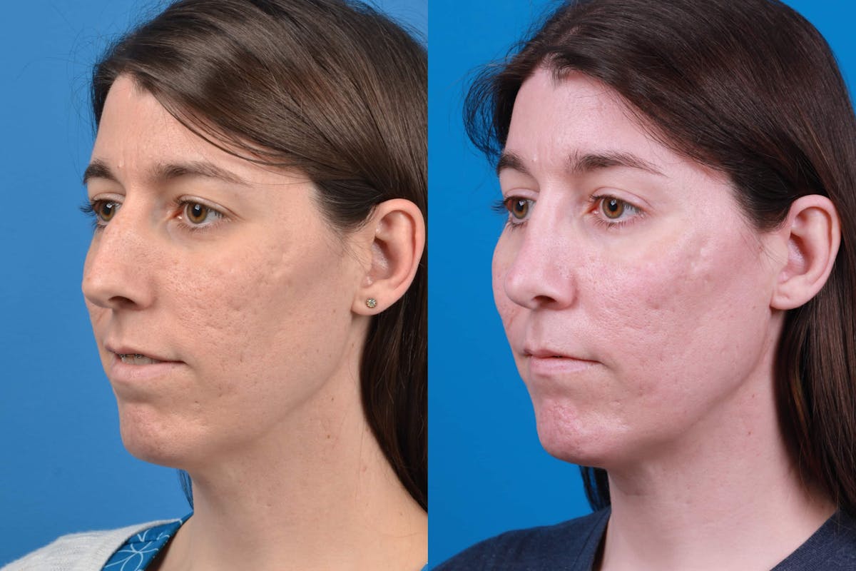 Facial Feminization Before & After Gallery - Patient 122595434 - Image 2