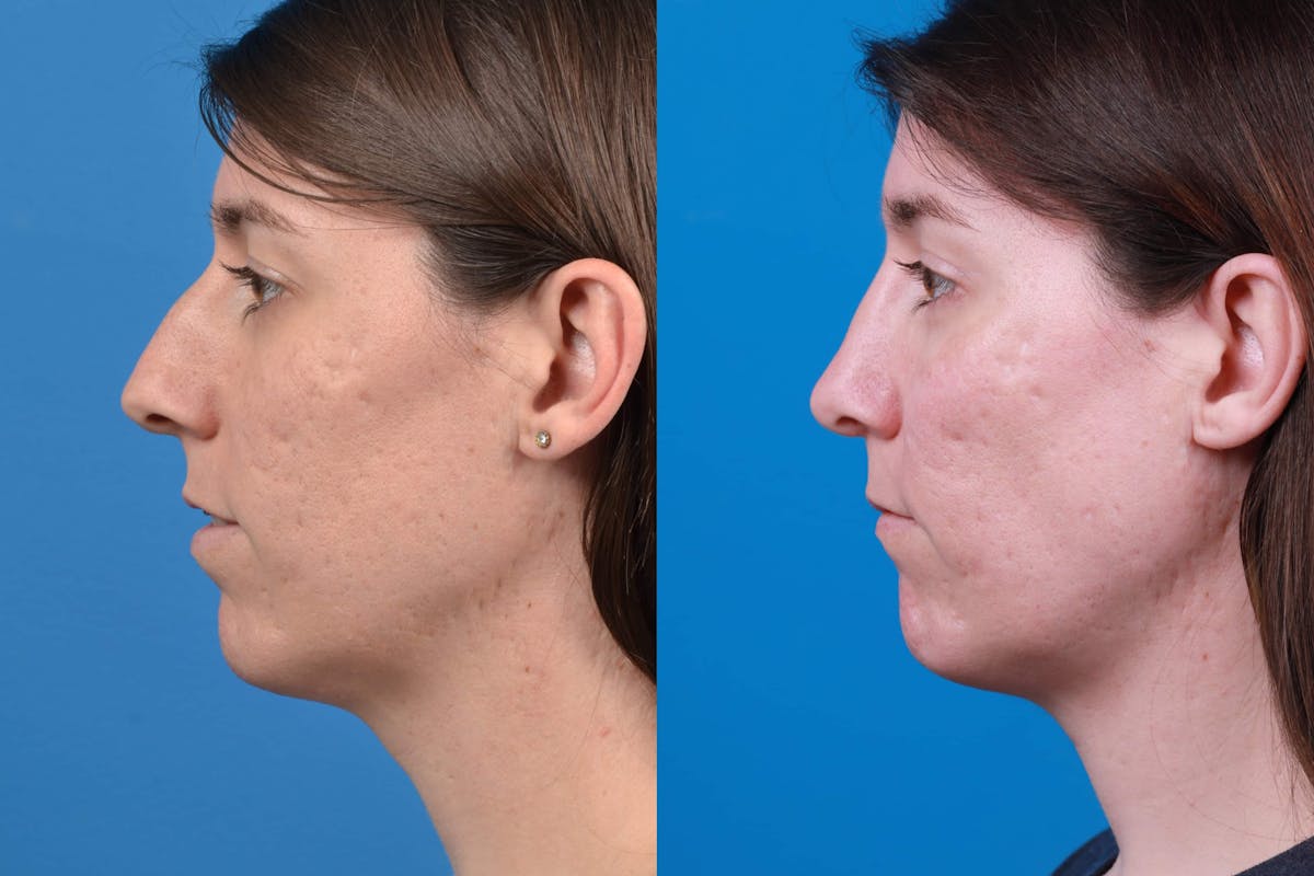 Facial Feminization Before & After Gallery - Patient 122595434 - Image 1
