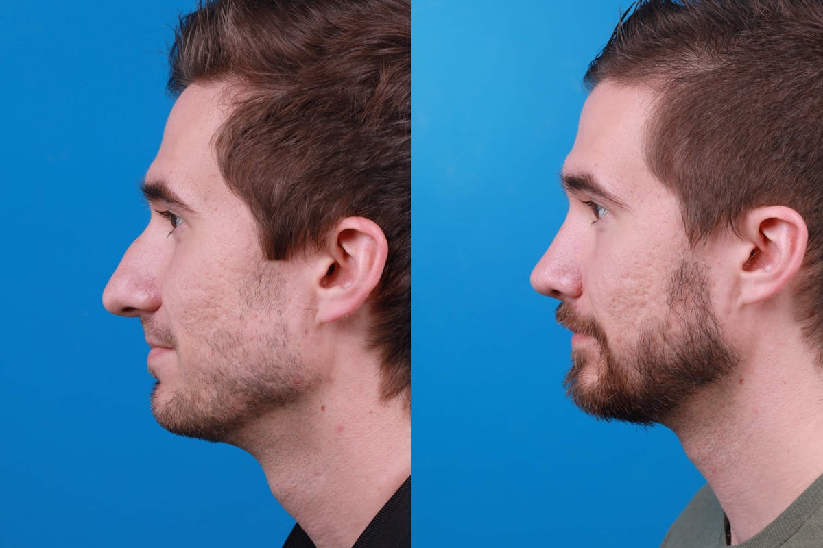 Rhinoplasty Before & After Gallery - Patient 122594364 - Image 5