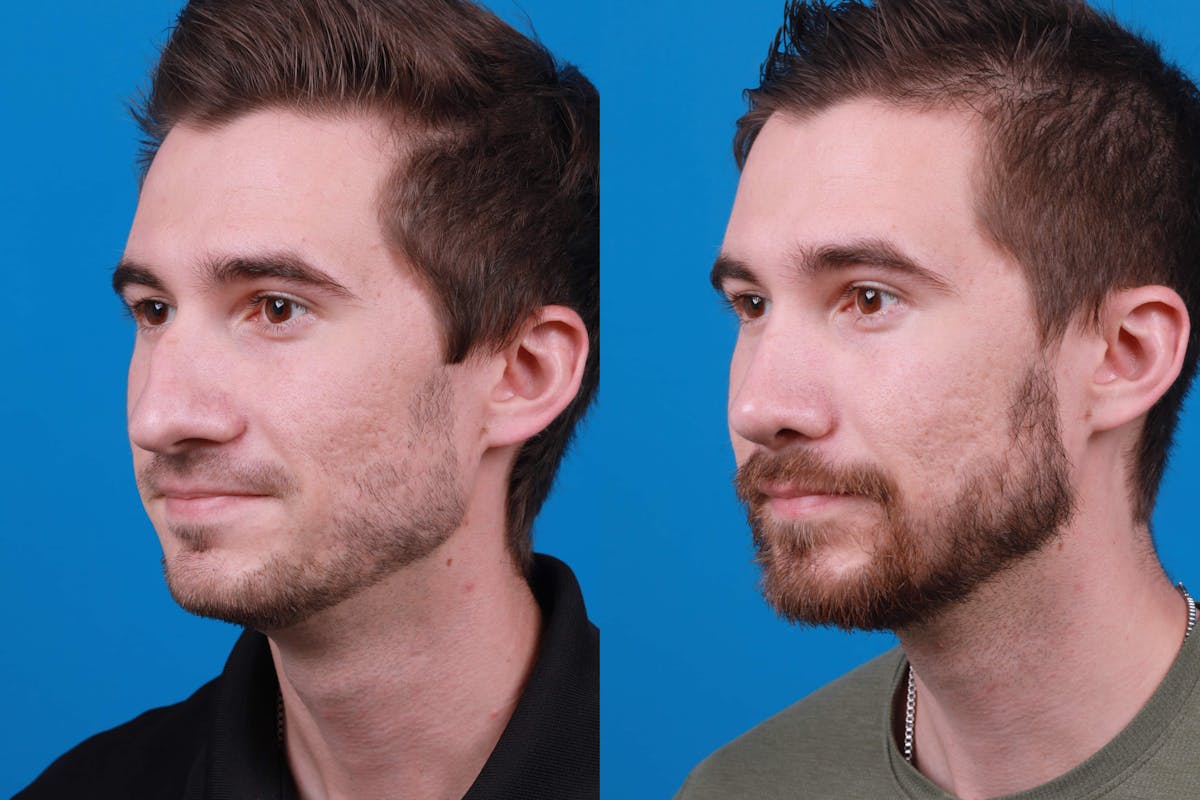 Rhinoplasty Before & After Gallery - Patient 122594364 - Image 4