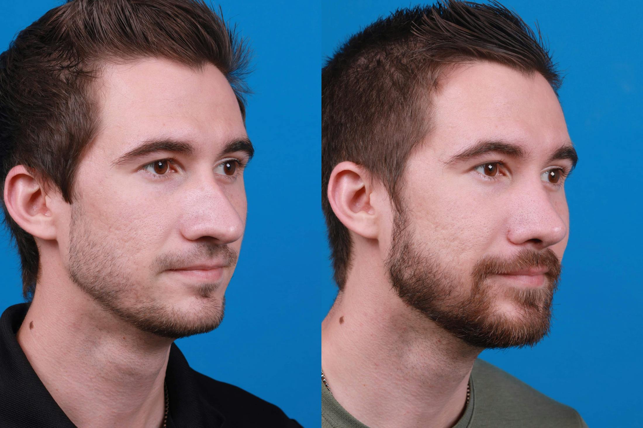 Rhinoplasty Before & After Gallery - Patient 122594364 - Image 2
