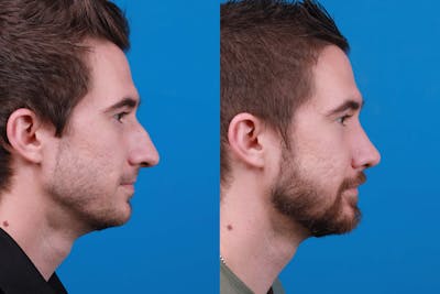 Rhinoplasty Before & After Gallery - Patient 122594364 - Image 1