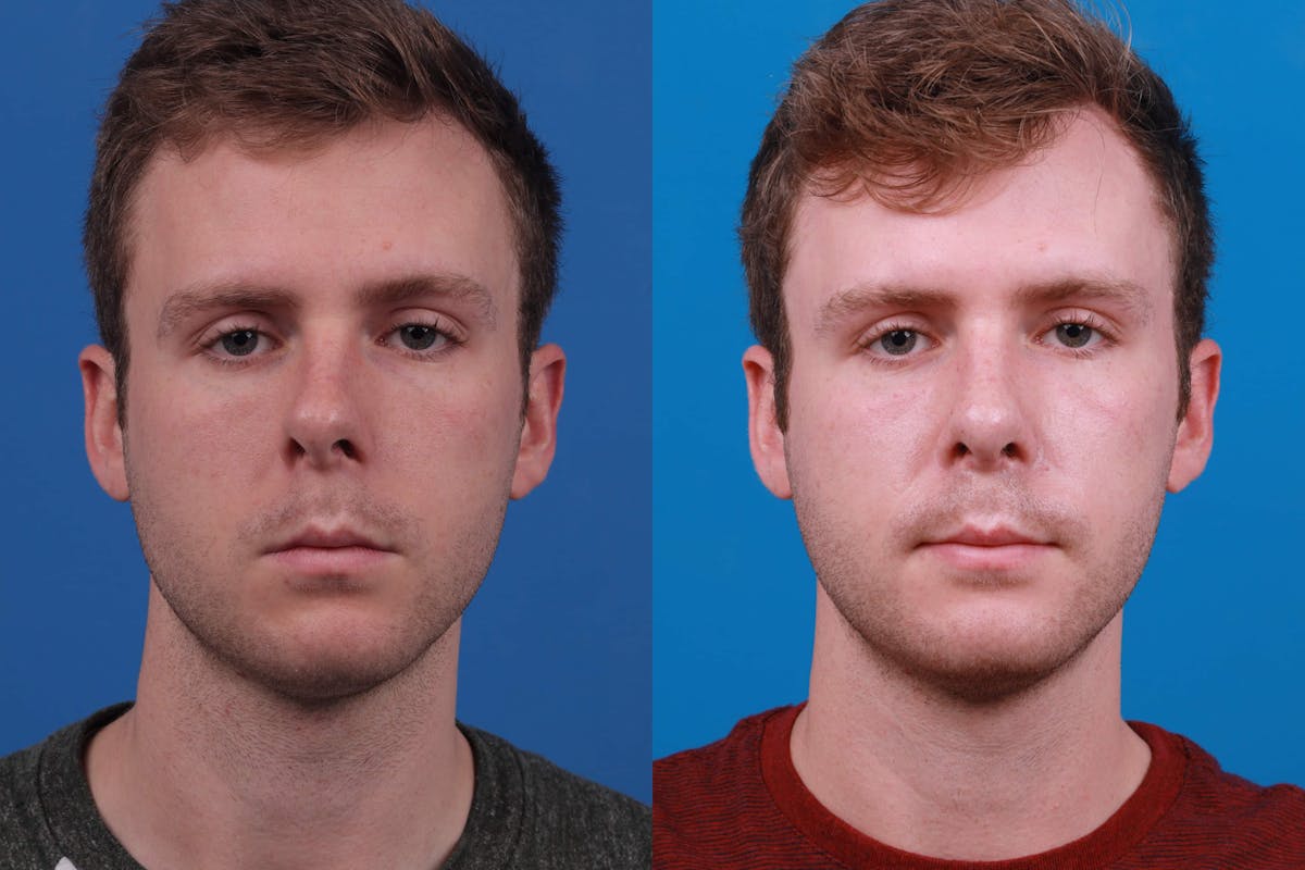 Rhinoplasty Before & After Gallery - Patient 122594280 - Image 1