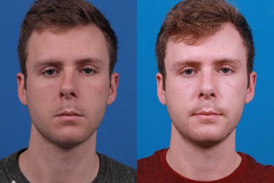 Rhinoplasty Before & After Gallery - Patient 122594280 - Image 1