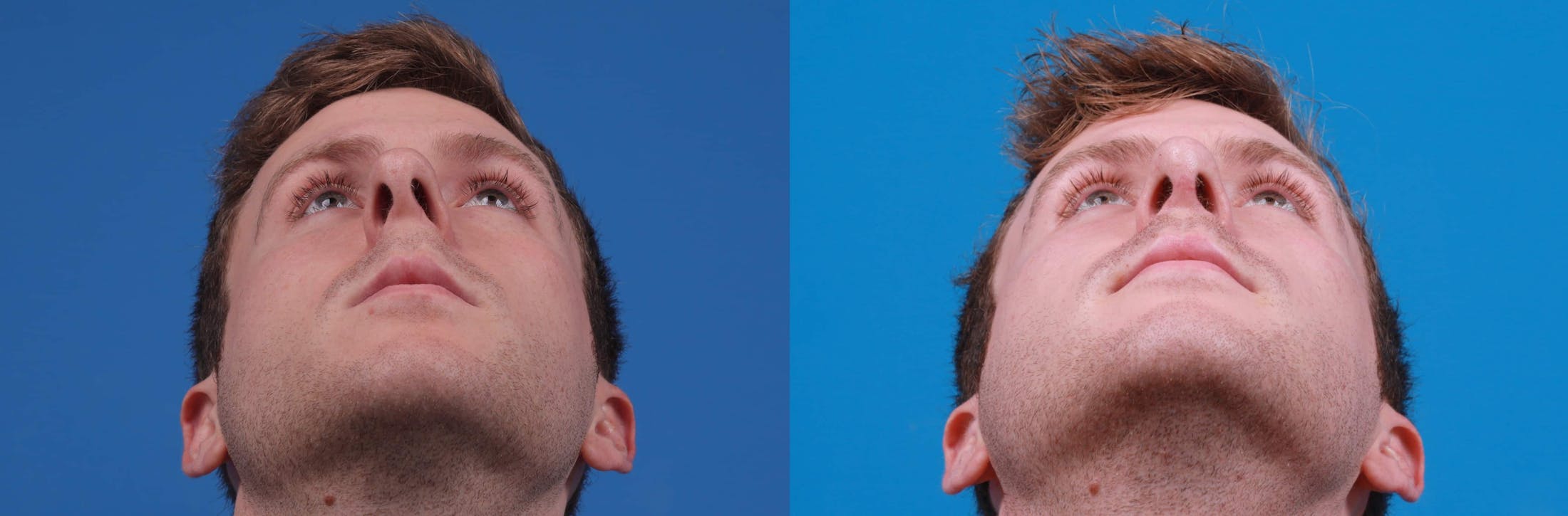 Rhinoplasty Before & After Gallery - Patient 122594280 - Image 2