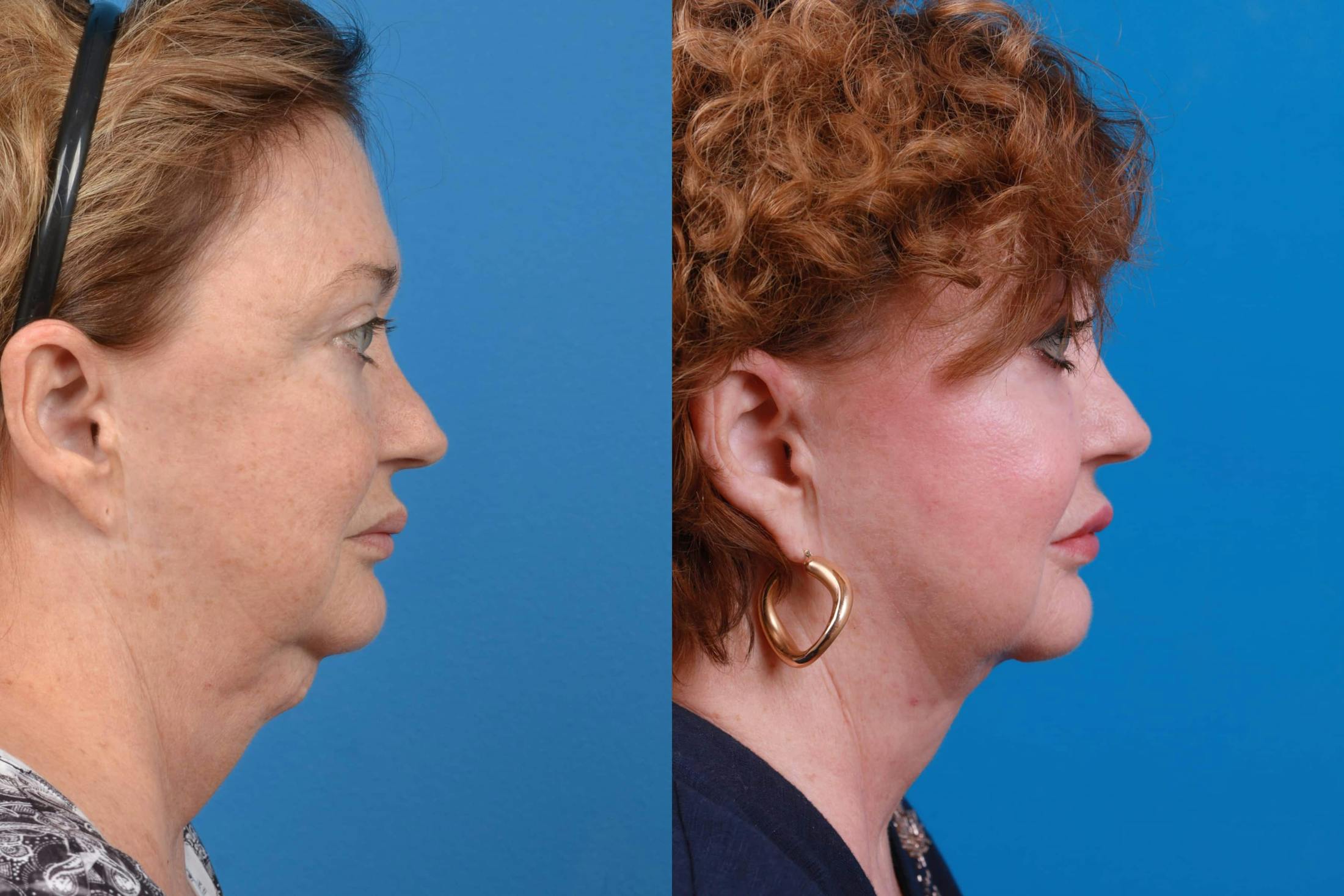 Profile Neck Lift Before & After Gallery - Patient 122594278 - Image 2