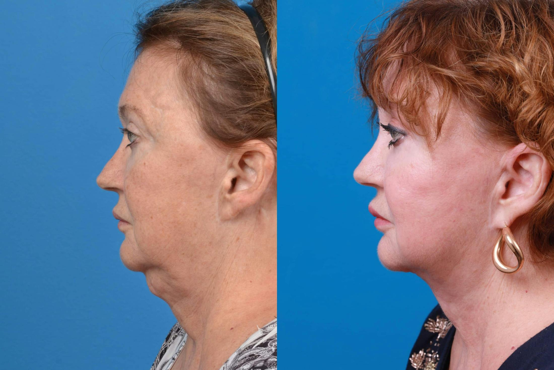 Profile Neck Lift Before & After Gallery - Patient 122594278 - Image 1