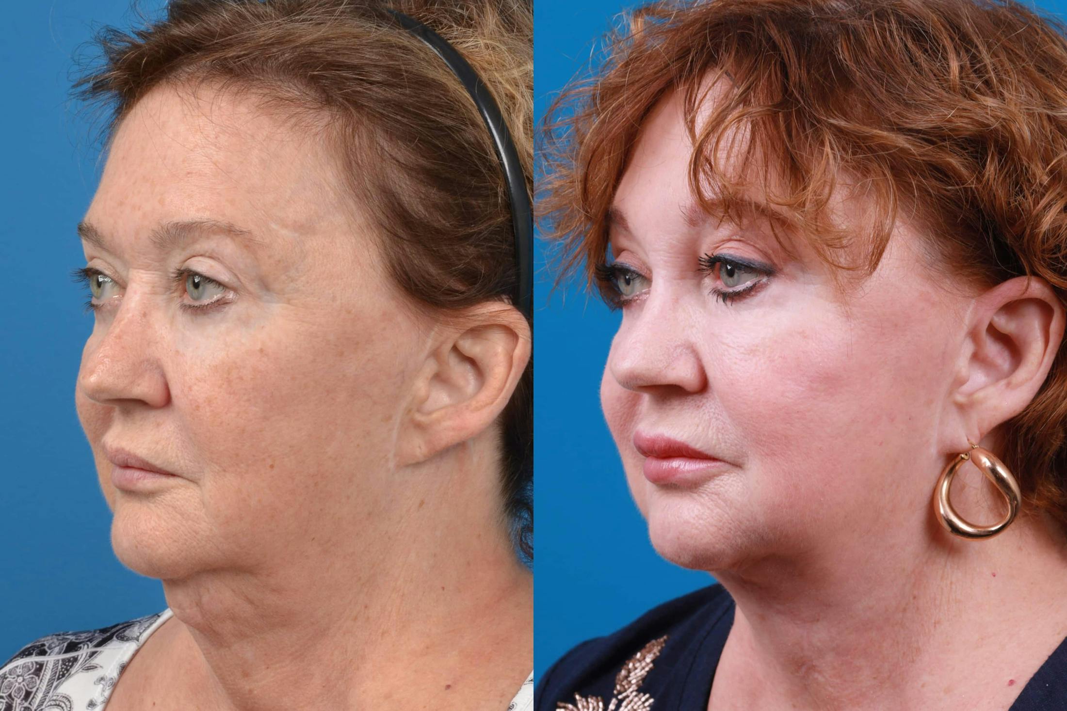 Lip Lift Before & After Gallery - Patient 122594272 - Image 3