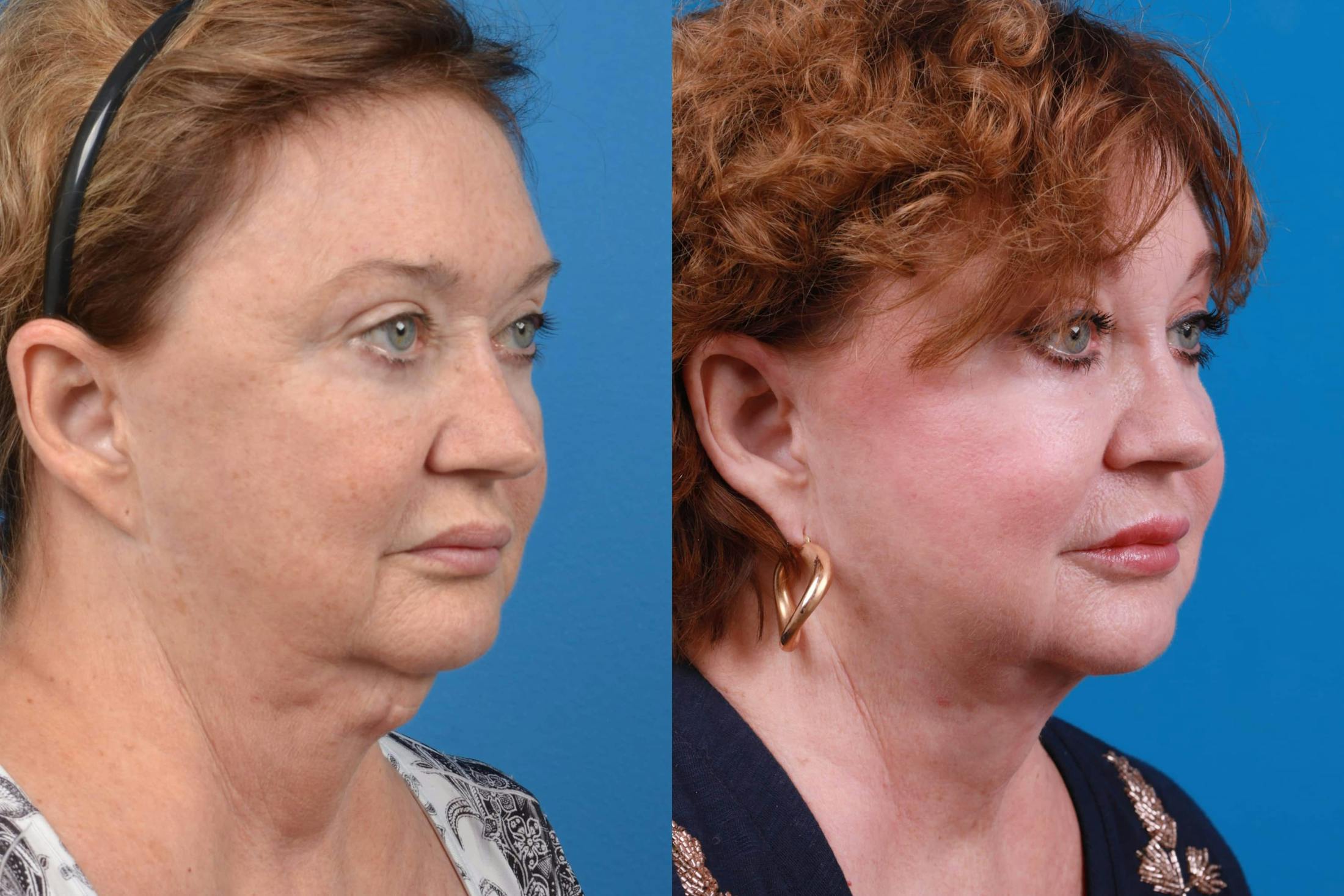 Lip Lift Before & After Gallery - Patient 122594272 - Image 2