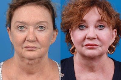 Lip Lift Before & After Gallery - Patient 122594272 - Image 1