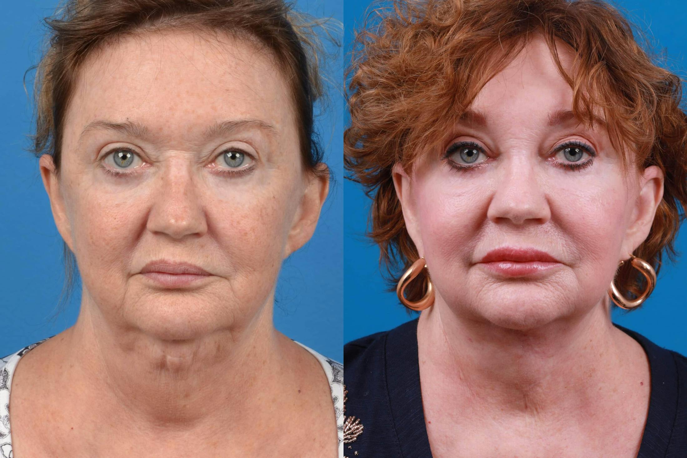 Lip Lift Before & After Gallery - Patient 122594272 - Image 1