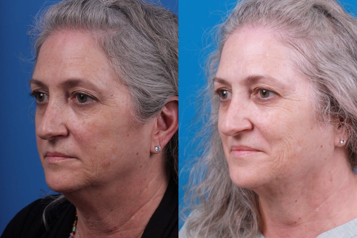 Express Lift Before & After Gallery - Patient 122592010 - Image 5