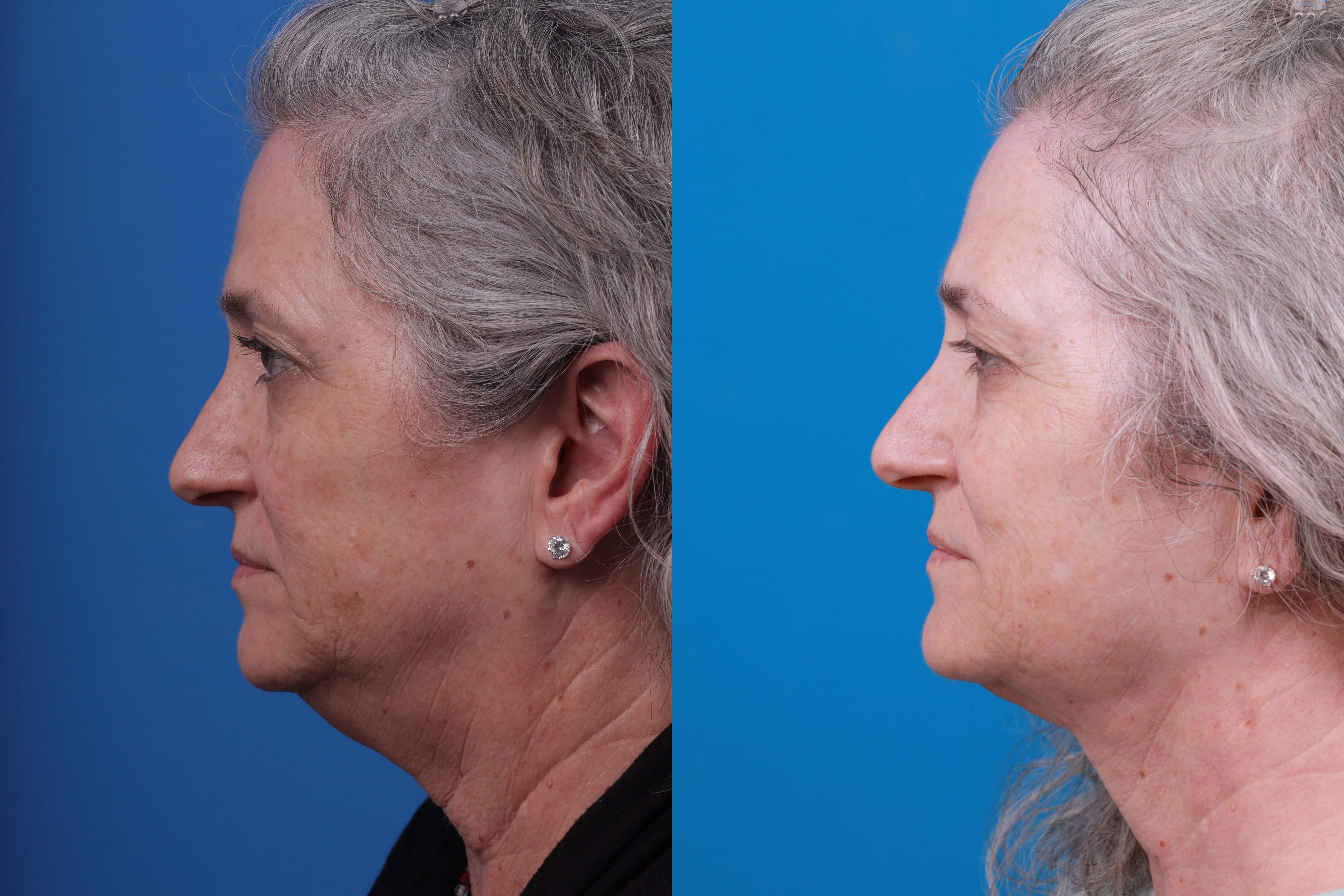 Express Lift Before & After Gallery - Patient 122592010 - Image 4