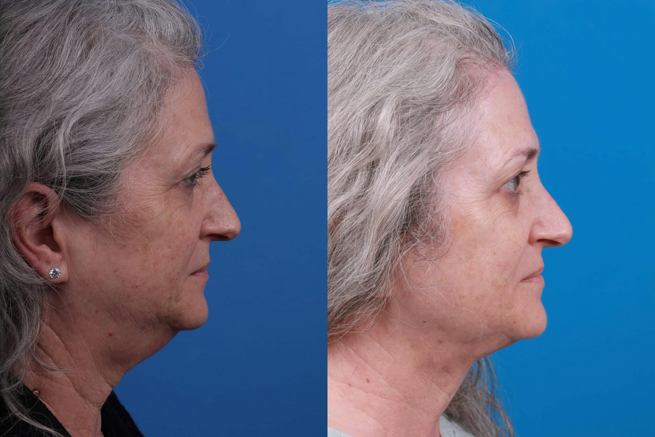 Express Lift Before & After Gallery - Patient 122592010 - Image 3