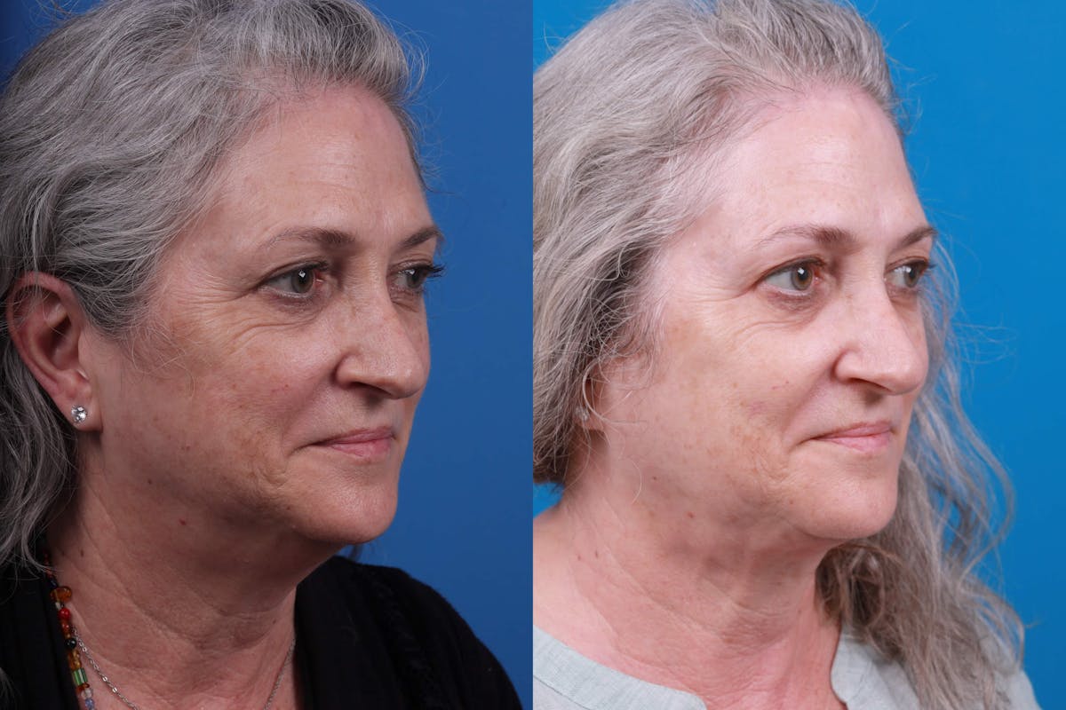 Express Lift Before & After Gallery - Patient 122592010 - Image 2