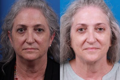 Express Lift Before & After Gallery - Patient 122592010 - Image 1
