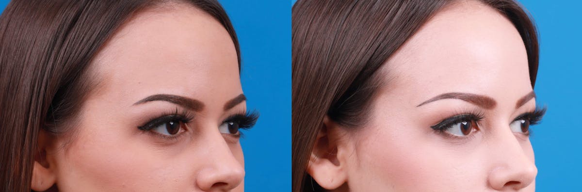 Dermal Fillers Before & After Gallery - Patient 122610219 - Image 2