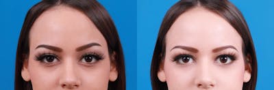 Dermal Fillers Before & After Gallery - Patient 122610219 - Image 1