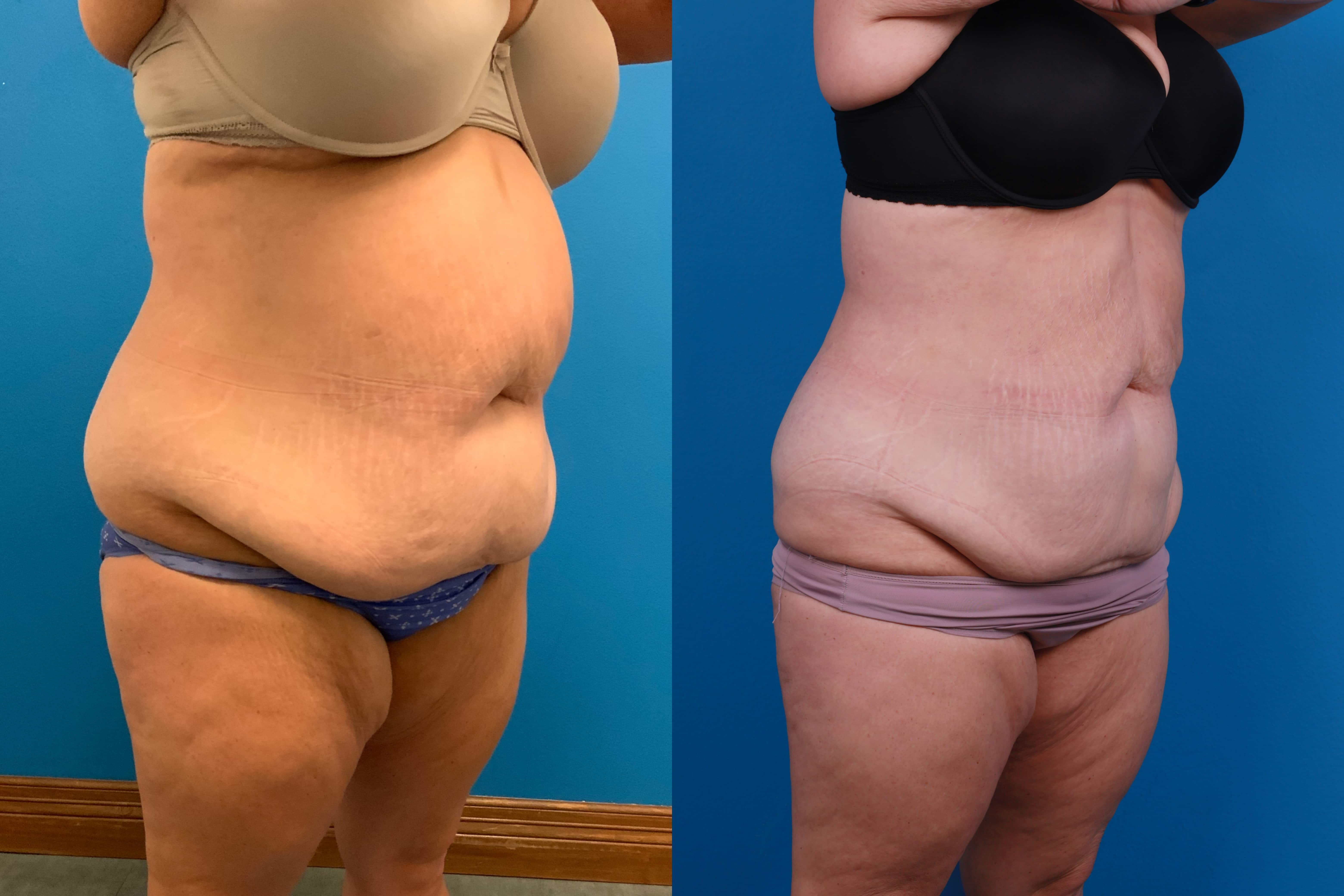 CoolSculpting Before & After Gallery - Patient 428361 - Image 5
