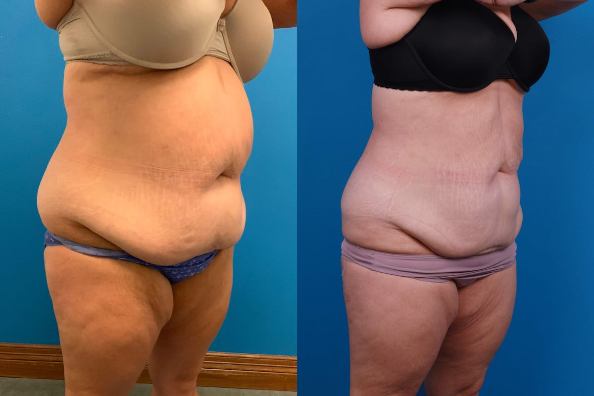 CoolSculpting Before & After Gallery - Patient 122594213 - Image 5