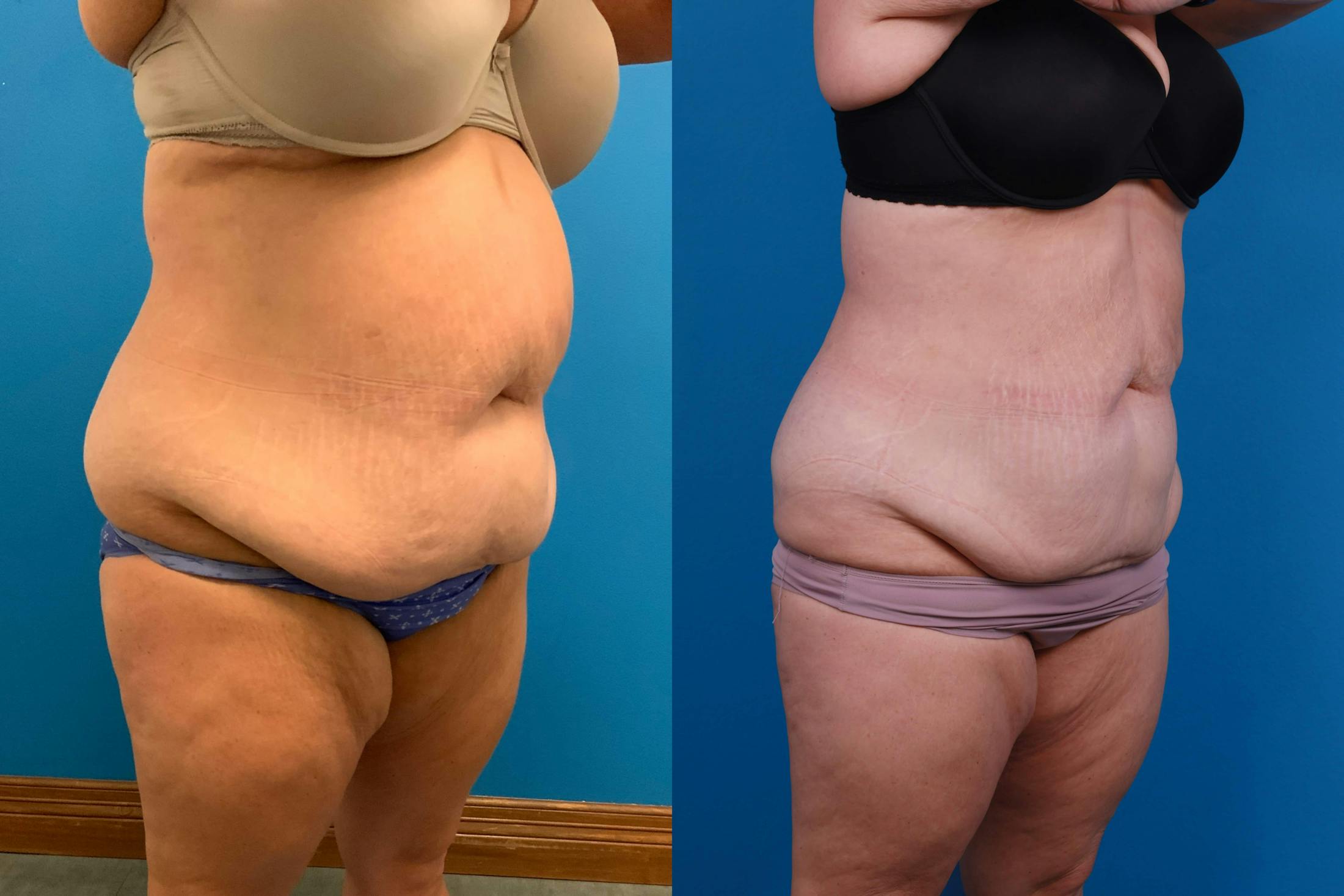 CoolSculpting Before & After Gallery - Patient 122594213 - Image 5