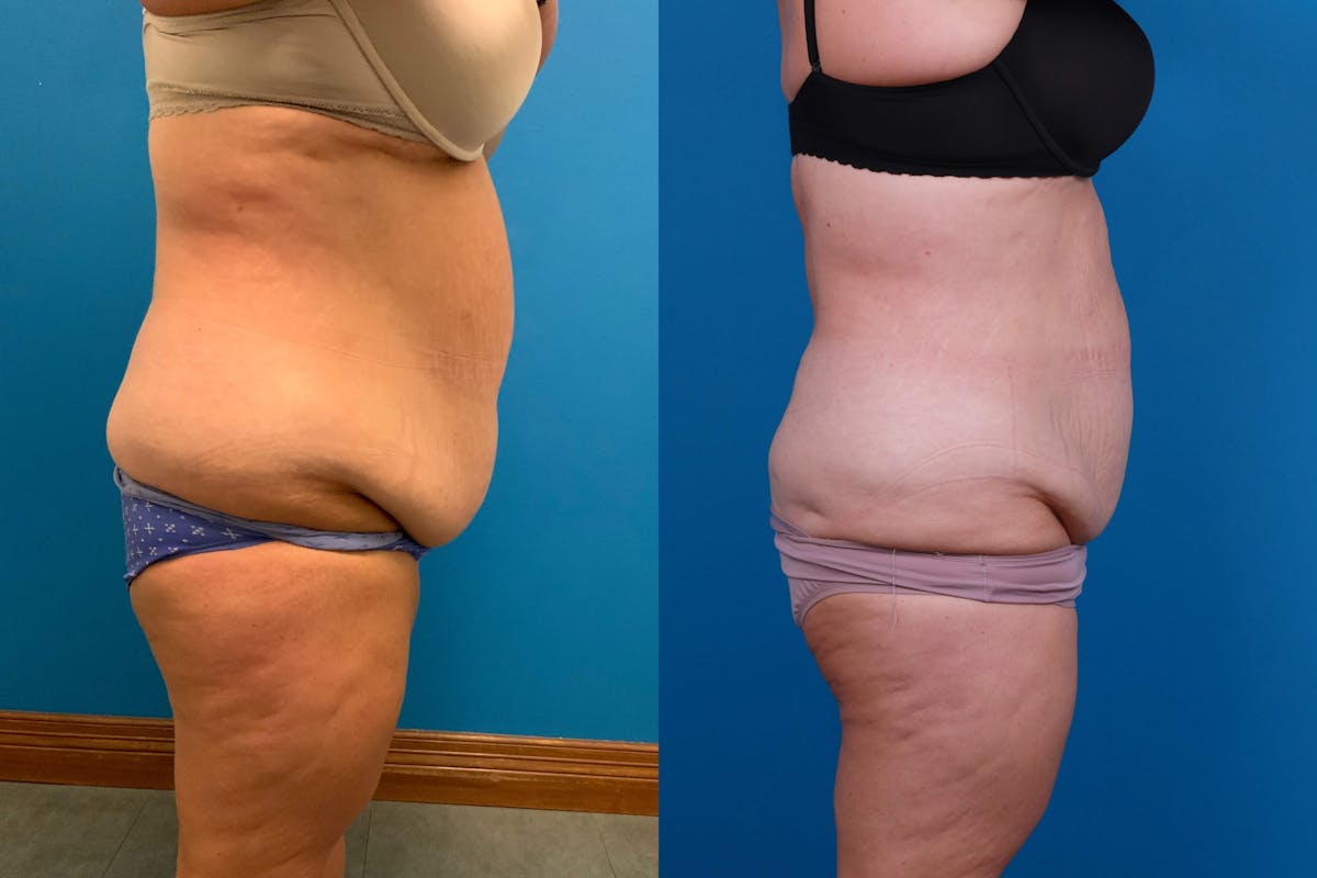 CoolSculpting Before & After Gallery - Patient 122594213 - Image 4