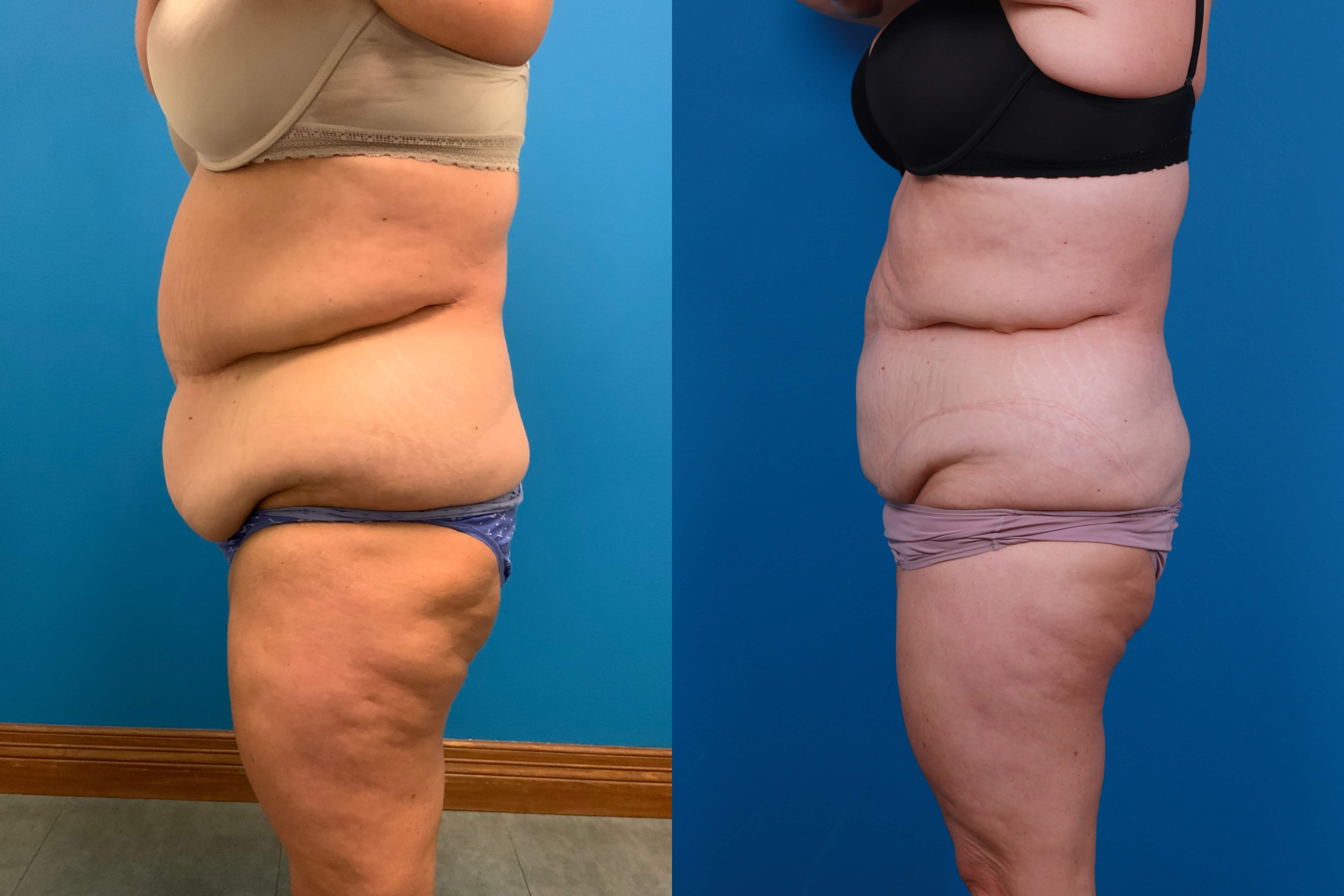 CoolSculpting Before & After Gallery - Patient 428361 - Image 3