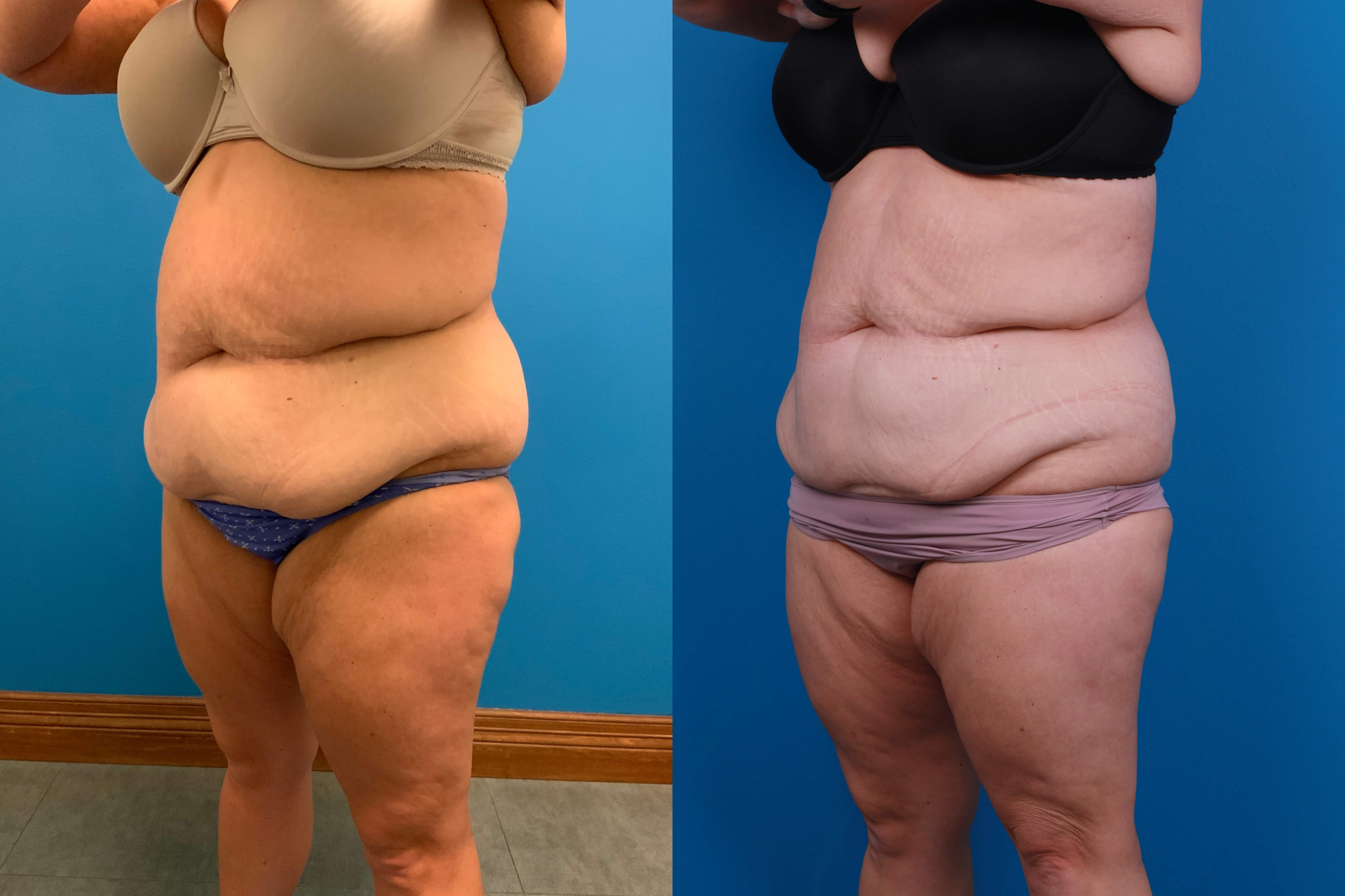 CoolSculpting Before & After Gallery - Patient 428361 - Image 2