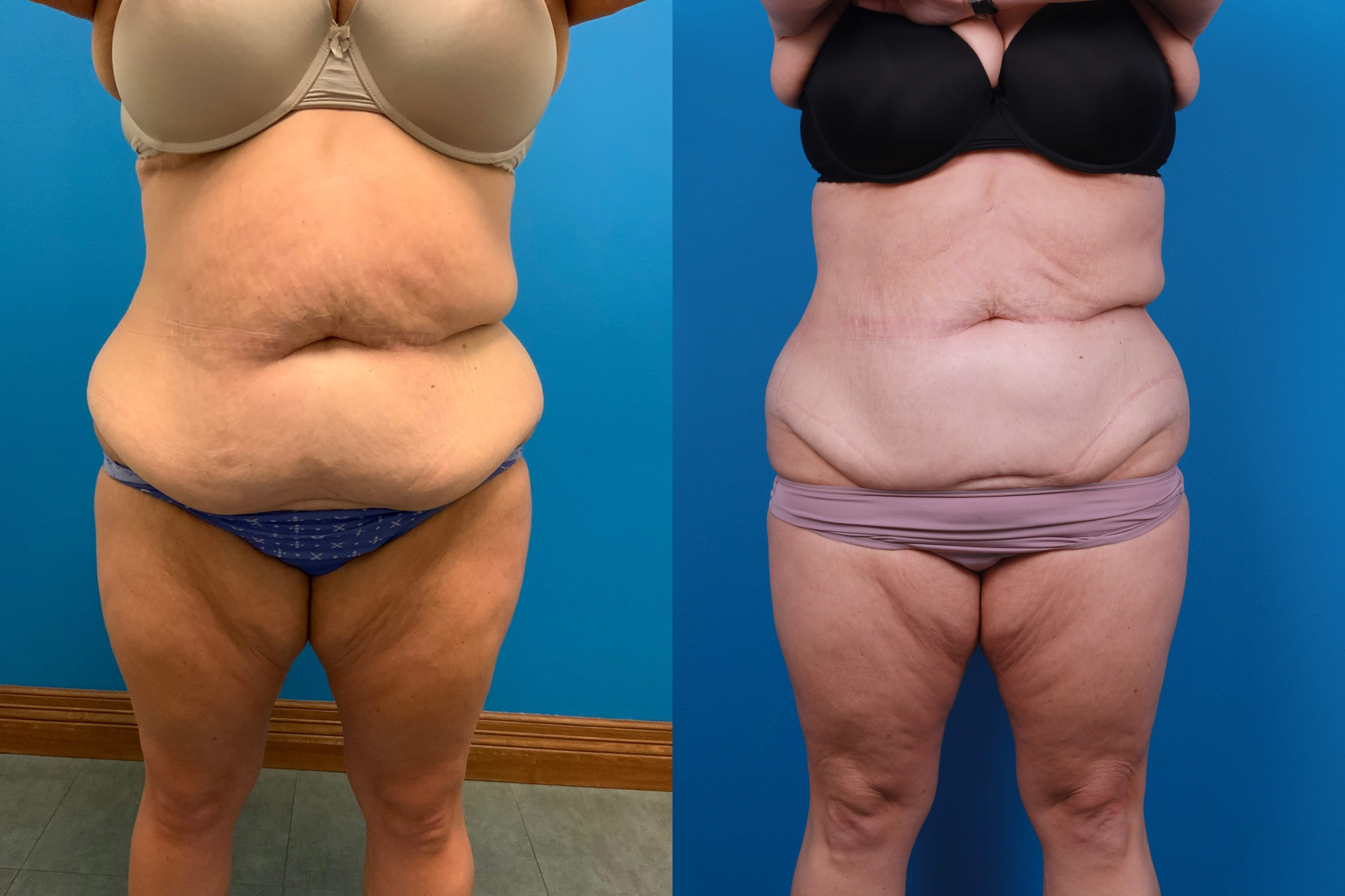 CoolSculpting Before & After Gallery - Patient 428361 - Image 1