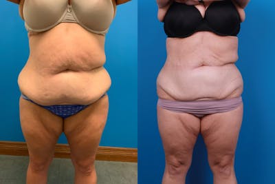 CoolSculpting Before & After Gallery - Patient 122594213 - Image 1