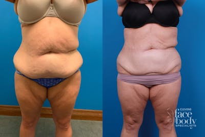 CoolSculpting Before & After Gallery - Patient 428361 - Image 1