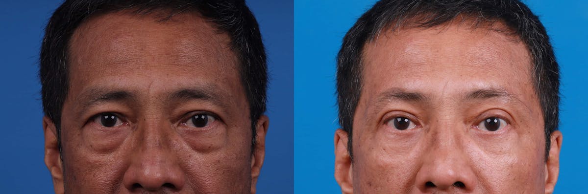 Eyelid Surgery Before & After Gallery - Patient 122594125 - Image 3