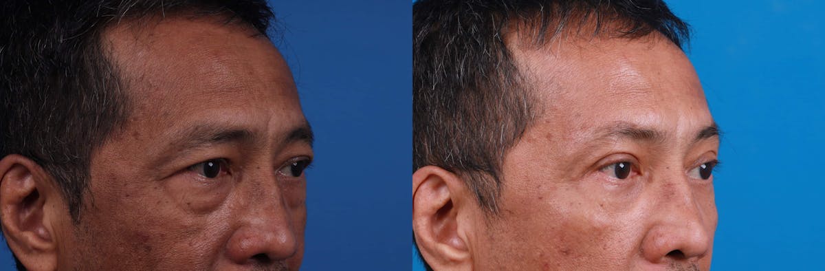 Brow Lift Before & After Gallery - Patient 122594149 - Image 2