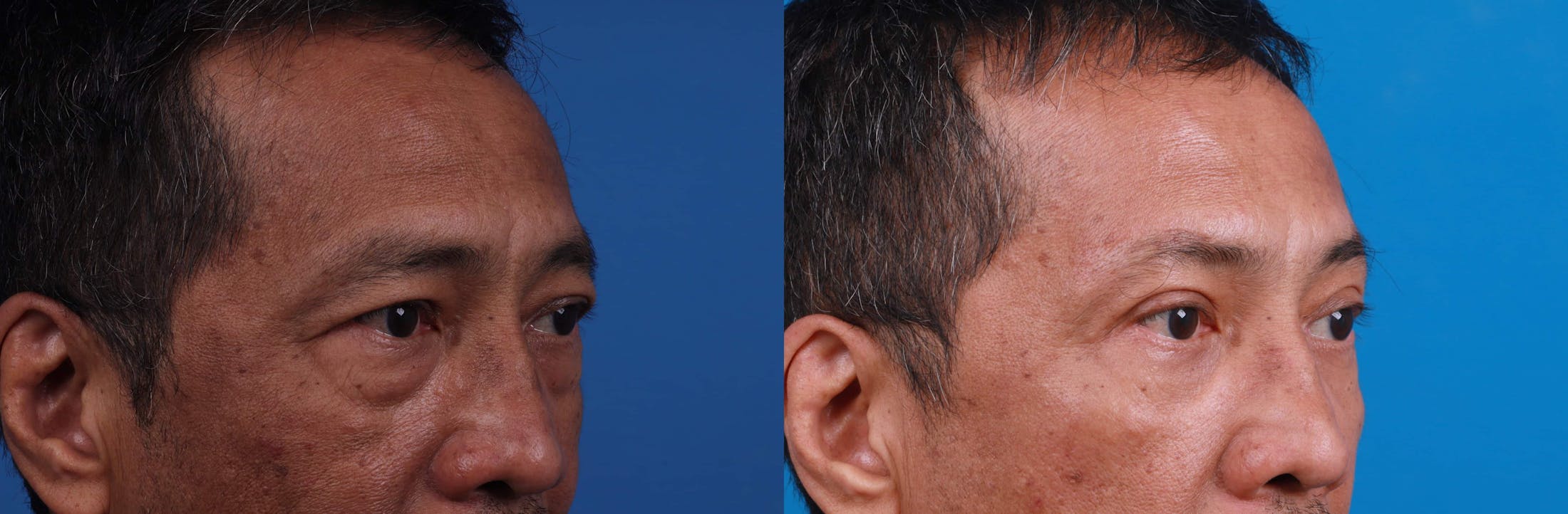 Eyelid Surgery Before & After Gallery - Patient 122594125 - Image 2