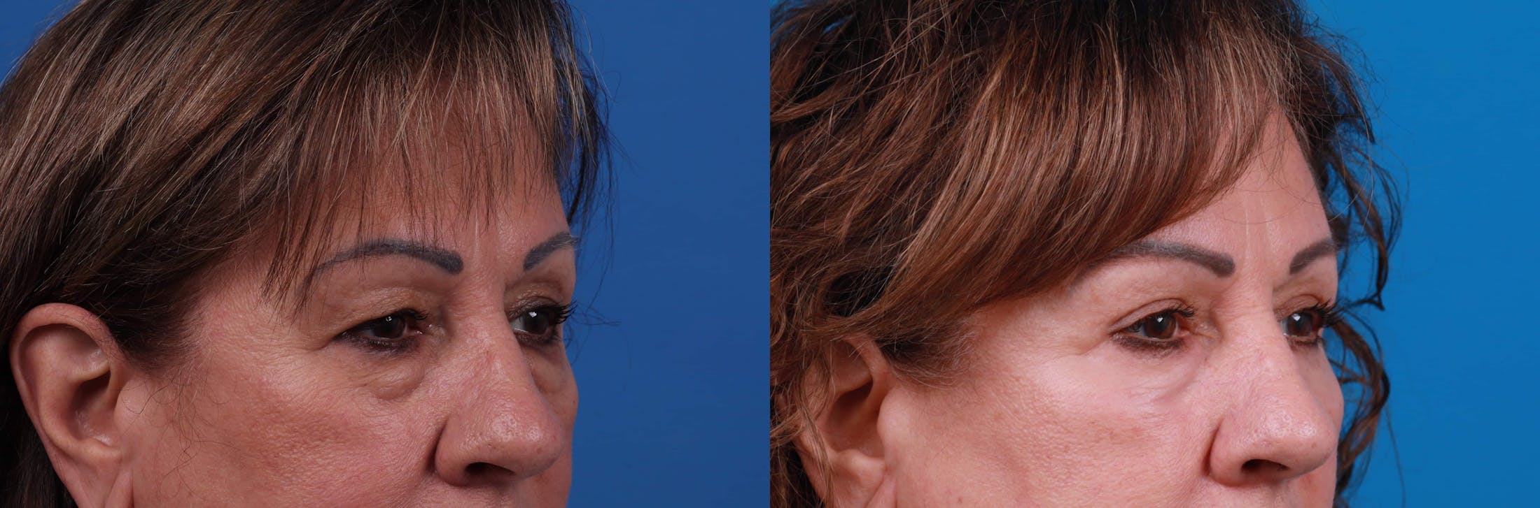 Eyelid Surgery Gallery - Patient 122594124 - Image 3