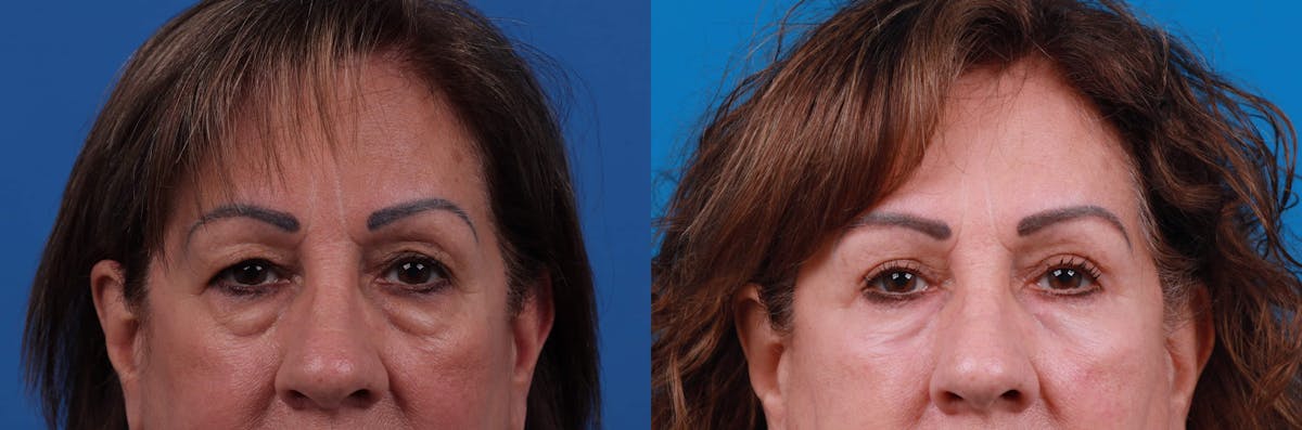 Eyelid Surgery Before & After Gallery - Patient 122594124 - Image 2