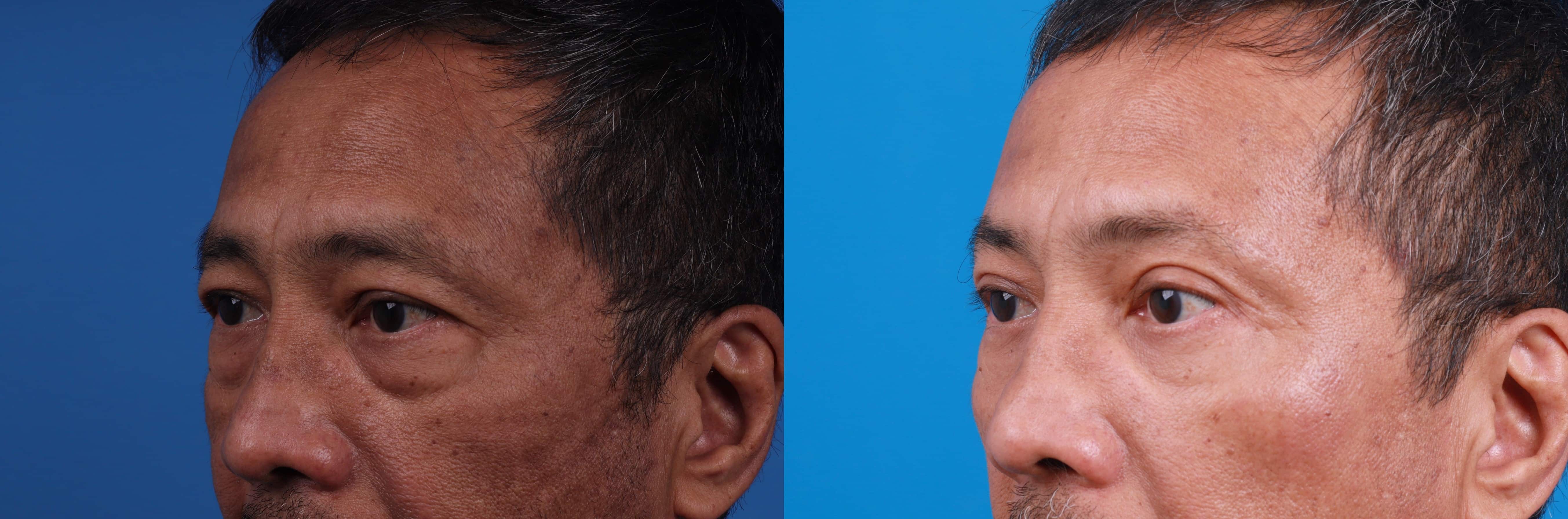 Brow Lift Before & After Gallery - Patient 122594149 - Image 1