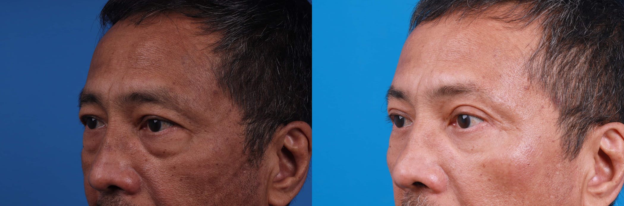 Eyelid Surgery