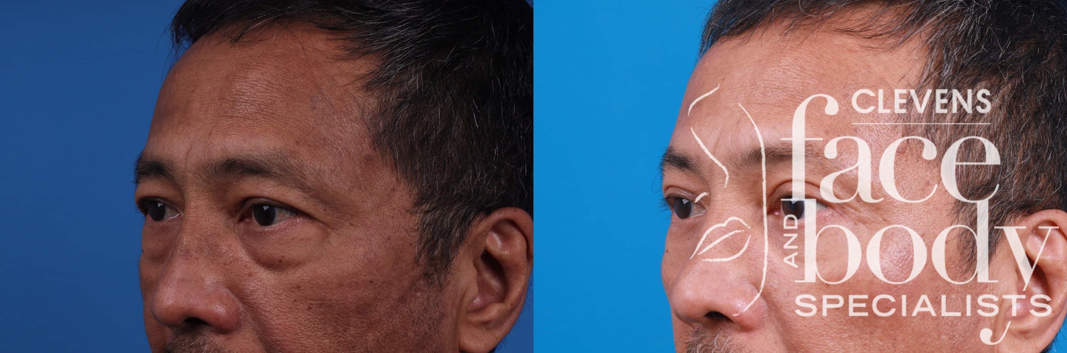 Eyelid Surgery