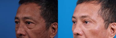 Brow Lift Before & After Gallery - Patient 122594149 - Image 1