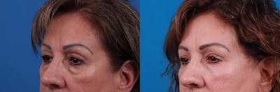 Eyelid Surgery Before & After Gallery - Patient 122594124 - Image 1