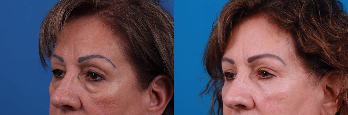 Eyelid Surgery Before & After Gallery - Patient 122594124 - Image 1
