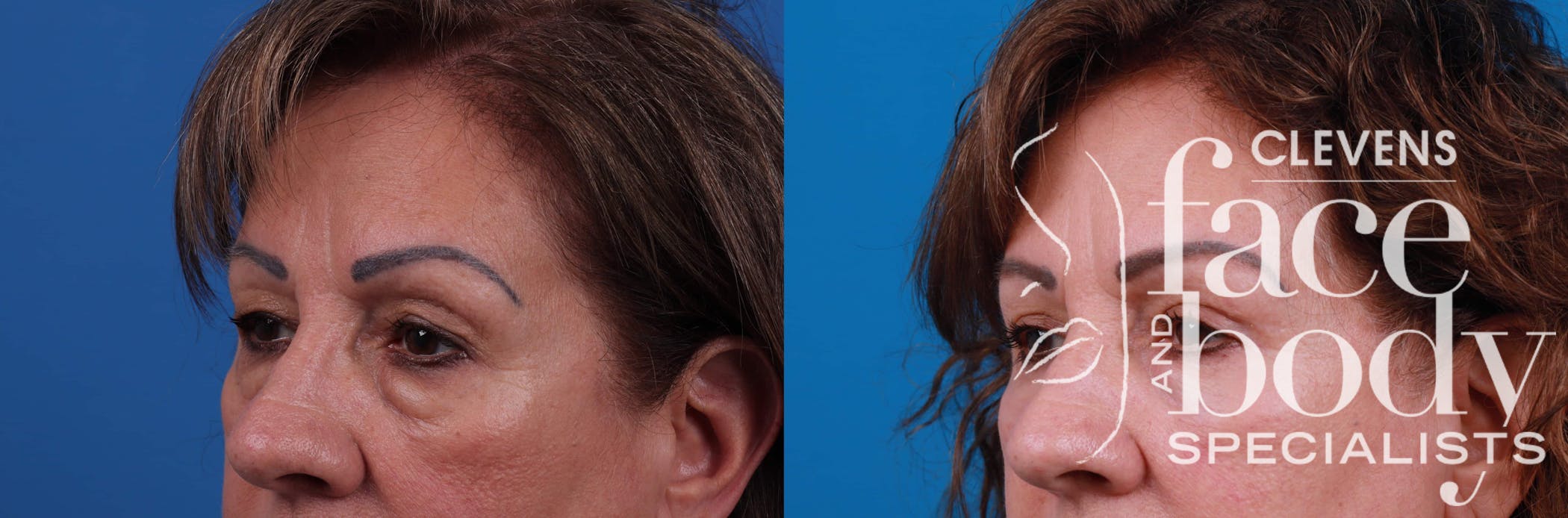 Eyelid Surgery