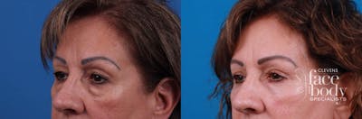 Eyelid Surgery Before & After Gallery - Patient 249919 - Image 1
