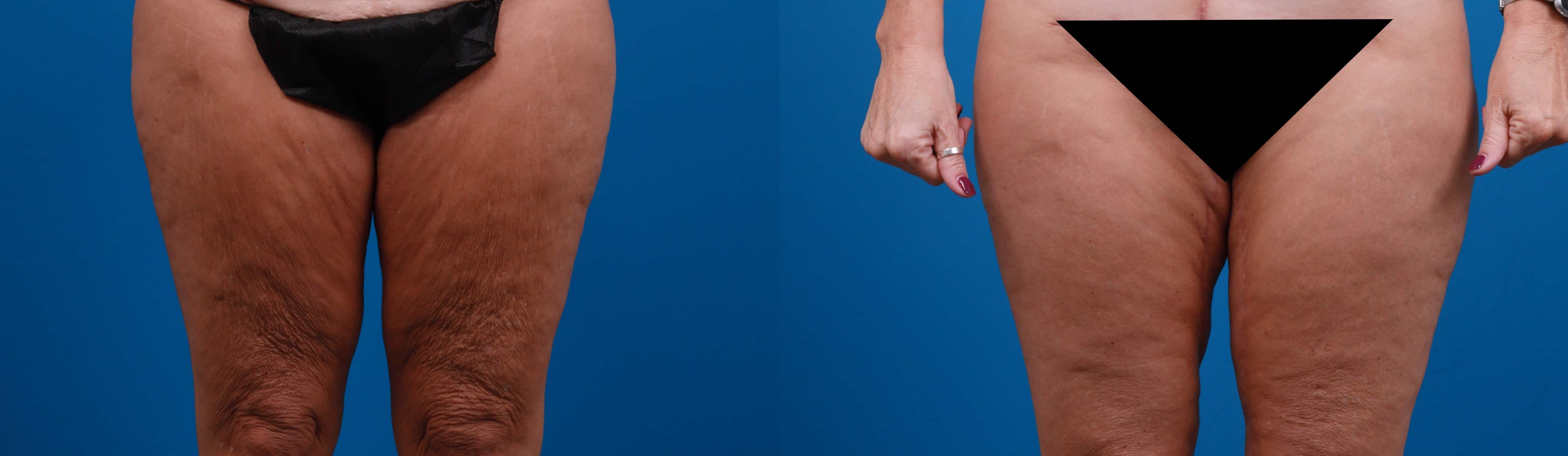 Hidden Thigh Lift Before & After Gallery - Patient 122594062 - Image 1