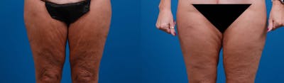 Thigh Lift Before & After Gallery - Patient 565876 - Image 1