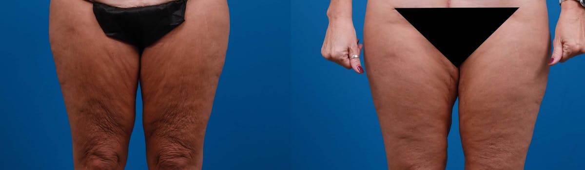 Thigh Lift Before & After Gallery - Patient 565876 - Image 1