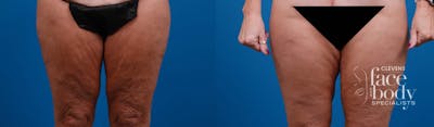 Hidden Thigh Lift Before & After Gallery - Patient 262013 - Image 1